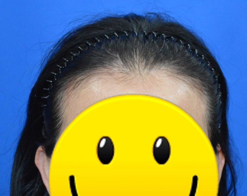 헤어라인교정전.jpg