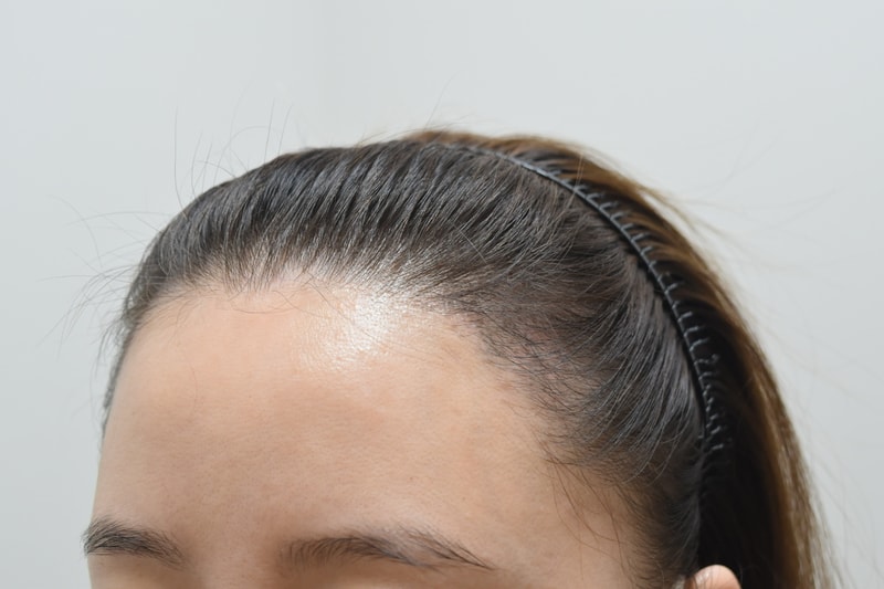 Daegu New Hair Women's Hairline after 3 months