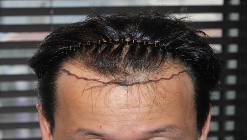수술당일(정면).jpg