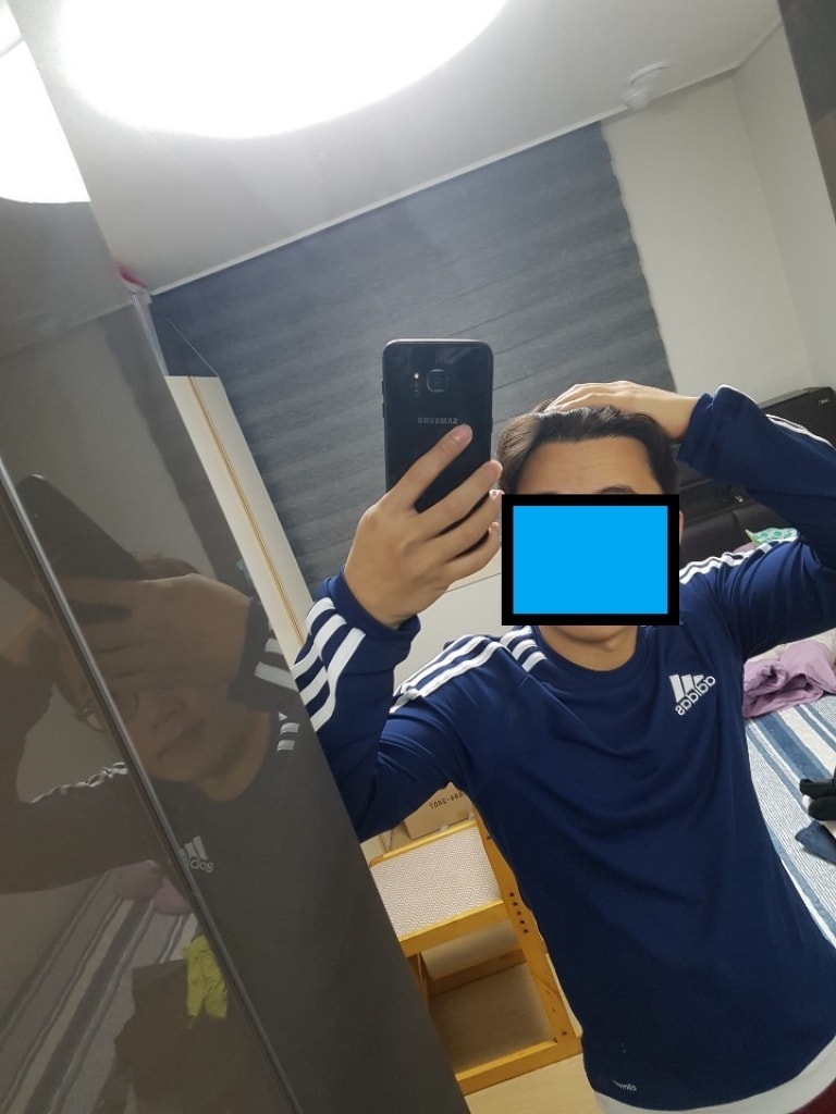 1400모낭 2900모 6개월