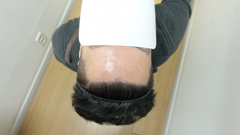 청담 자라다의원 모발이식 1년 4개월 경과 후기 올립니다.