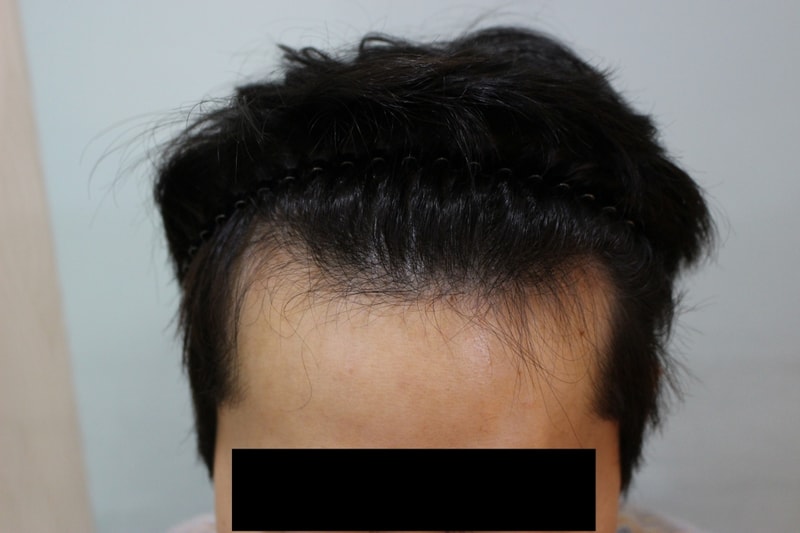 It's been 16 days since the M-shaped hair loss transplant