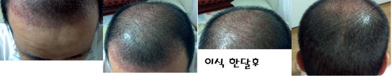 이식한달후.jpg