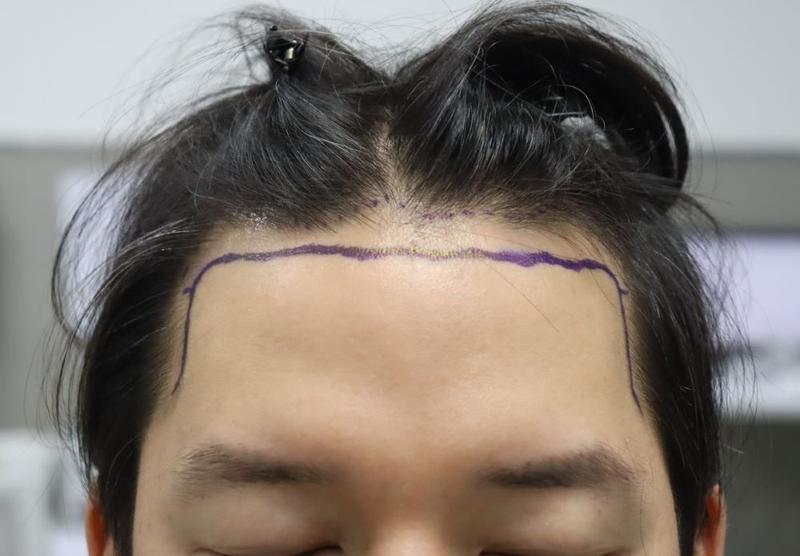 Apgujeong Pohair / As a result of the dense planting of thin hair / 5 months of dyeing after non-cut hair transplantation
