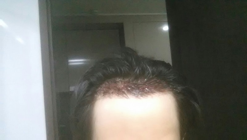 Right after 1300 follicle surgery, Day 1 post-mortem