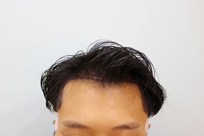 수술직후1.jpg
