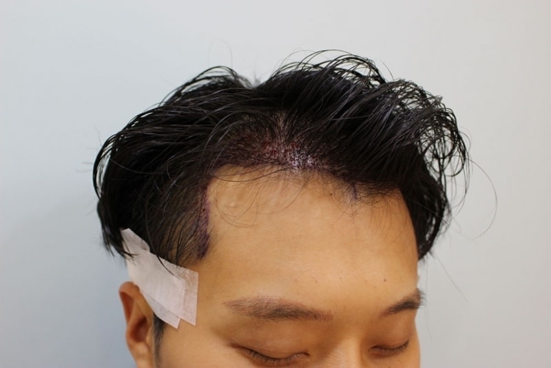 수술직후4.jpg