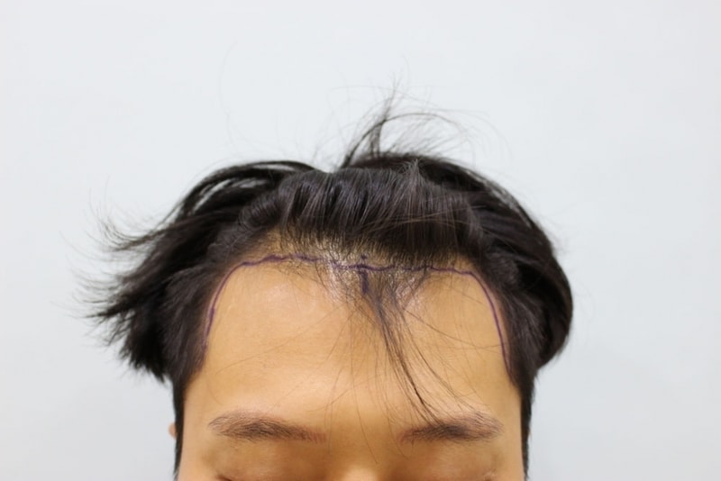 수술전1.jpg