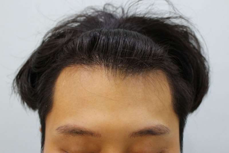 수술13일2.jpg