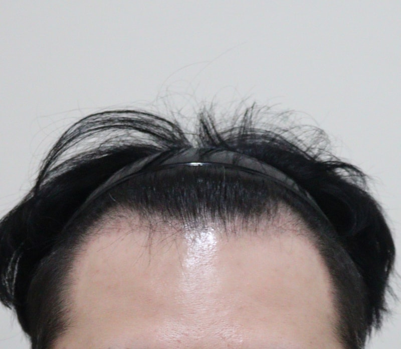 3. 수술후_3개월_1.JPG
