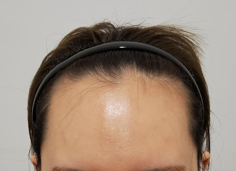 I can get out of the M-shaped hair loss!