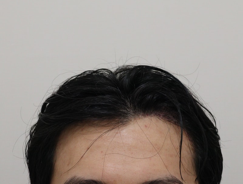 2. 수술후_2일_1.JPG