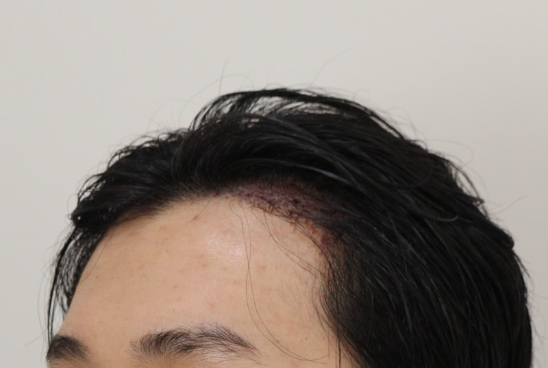 2. 수술후_2일_2.JPG