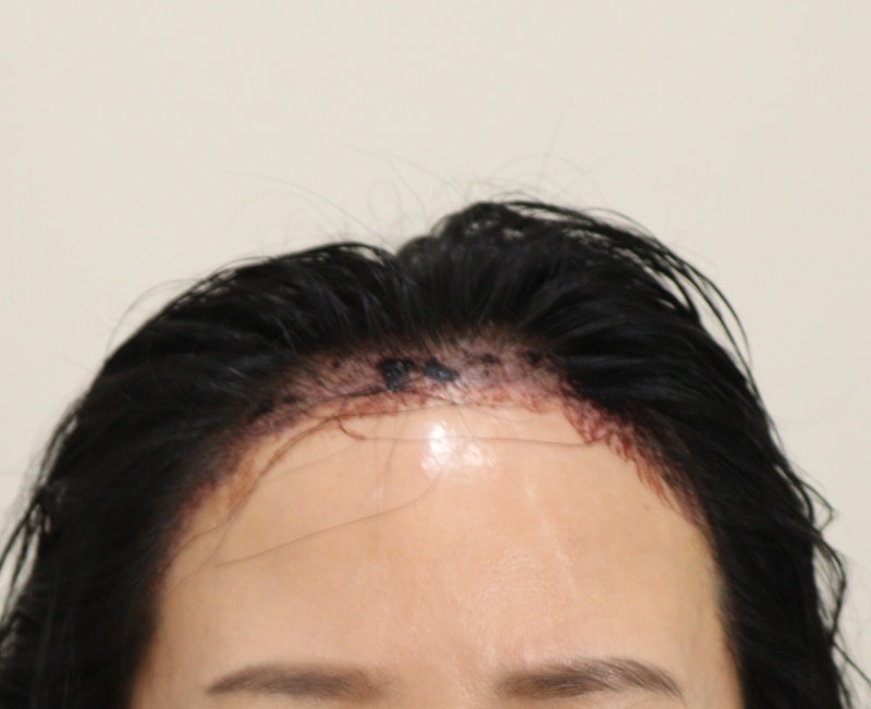 2. 수술후_1일_1.JPG