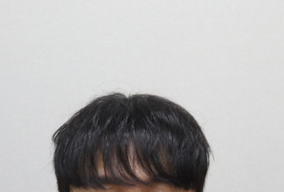 수술후앞머리.png