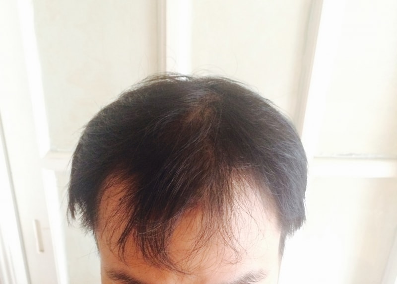 모발이식전.jpg