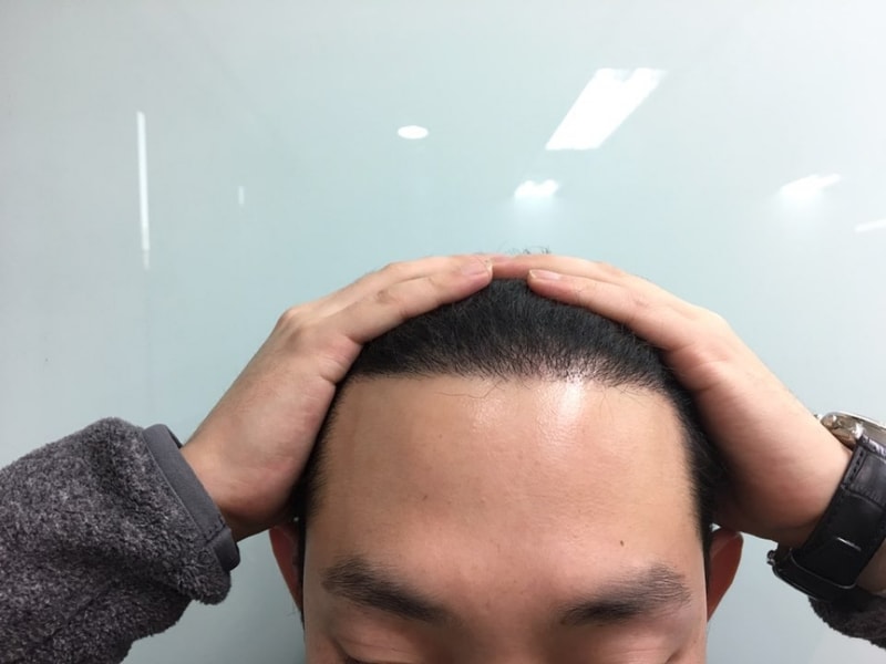 Maternal surgery 1400 hair follicle surgery 5 months ago