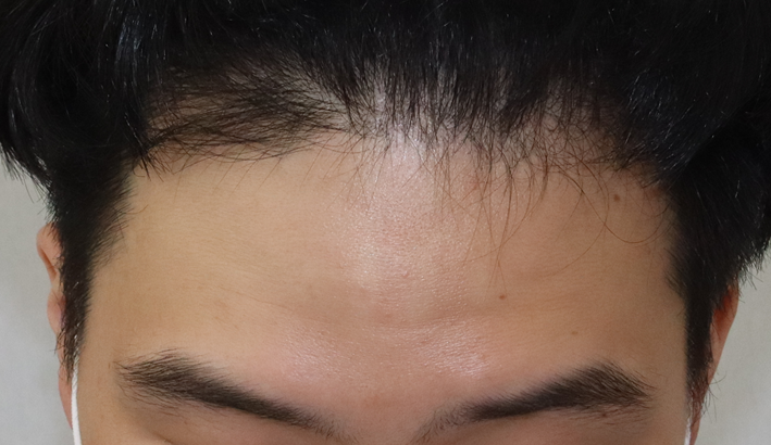It is a review of the mid-20s, about 9 months after the 2200 hair incision.