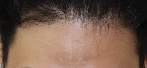 It is a review of about a year after 12 months of 2200 hair incision in the mid-20s.