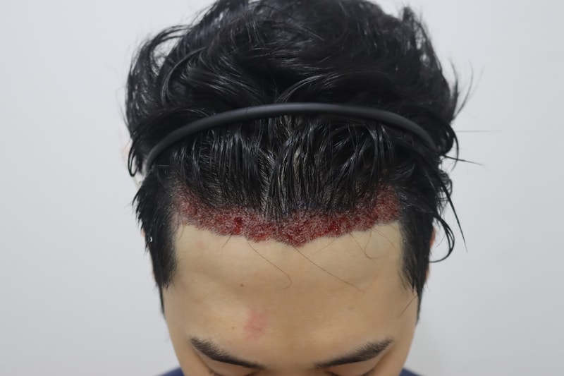 이식후.jpg