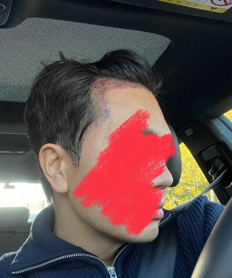 모아트의원 1150모낭 무삭발 비절개입니다.