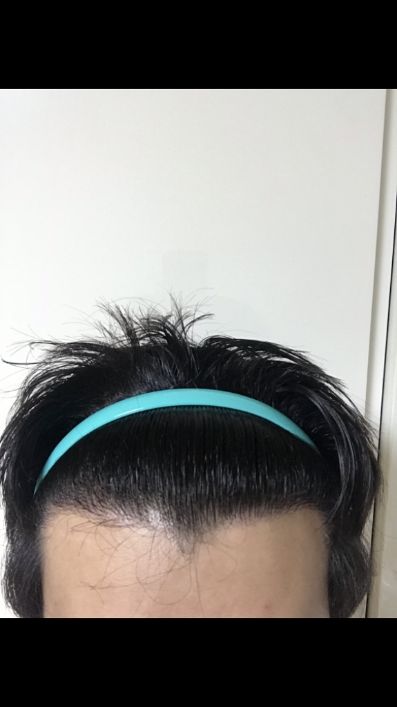 采用2017.4.3 1300毛囊部分削发非切开法进行手术。 上传术后第8个月的照片。