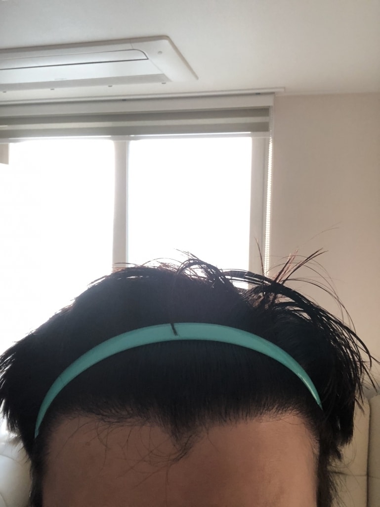 2017.4.3 1300毛囊部分削发非切开法手术后第1年的照片~