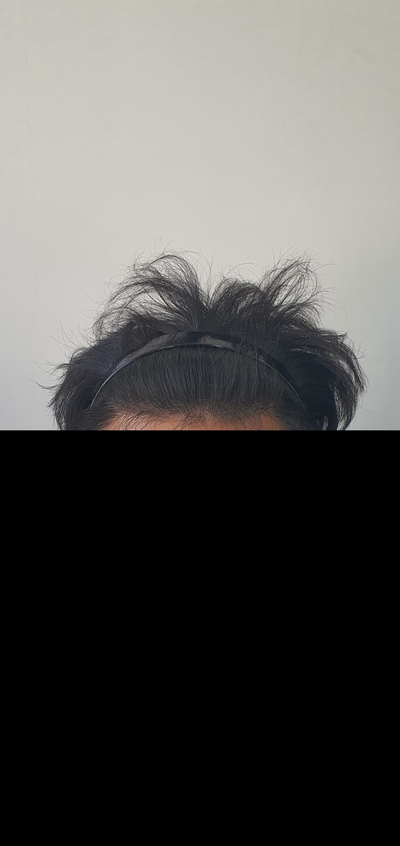 모재성 1800모낭 8개월차 후기