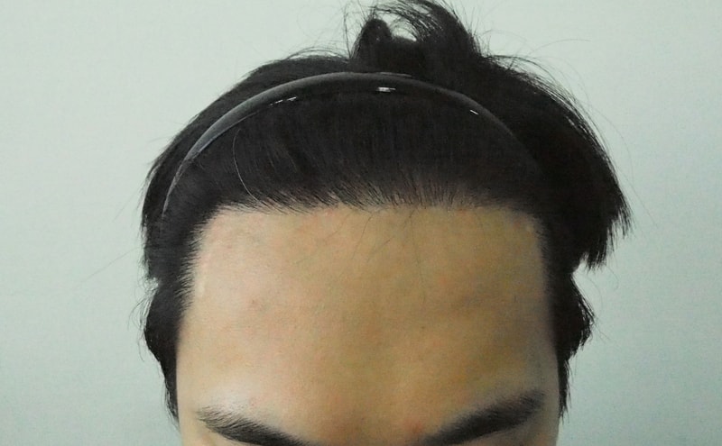 8 Months of Maternal Non-Cutting Surgery