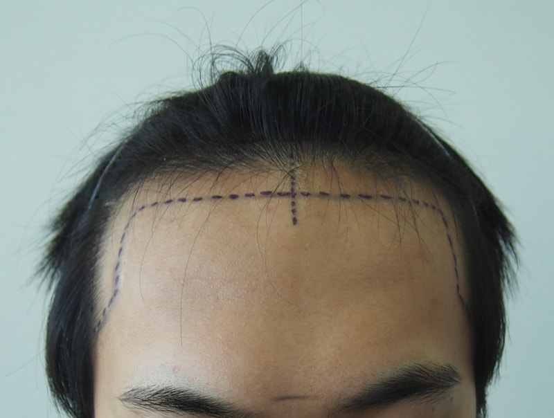 12 Months of Maternal Non-Cutting Surgery