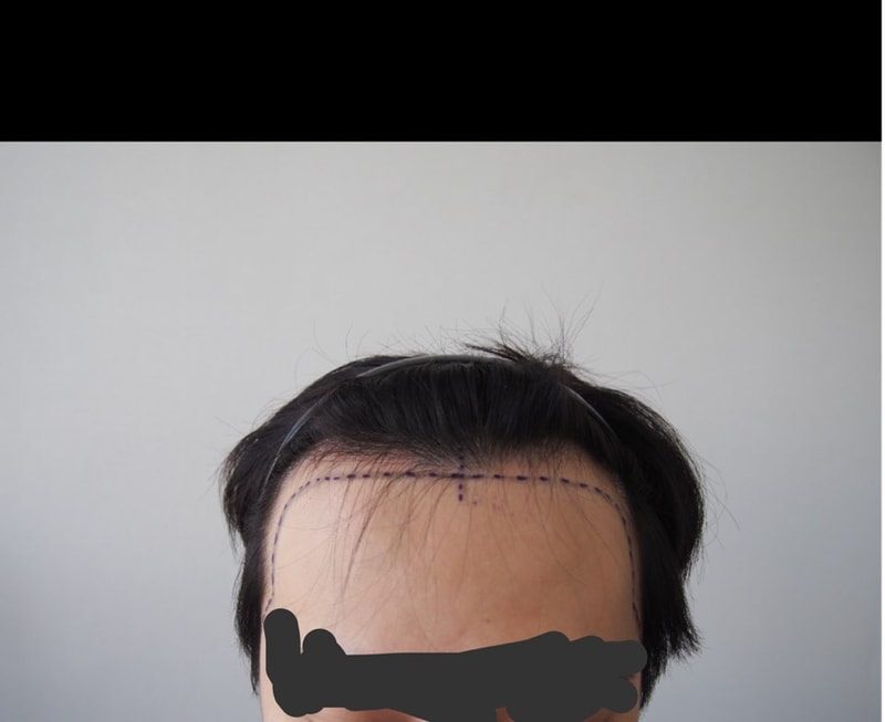 这是毛在成整形外科1900毛囊之后的手术后期。+2个月后的照片