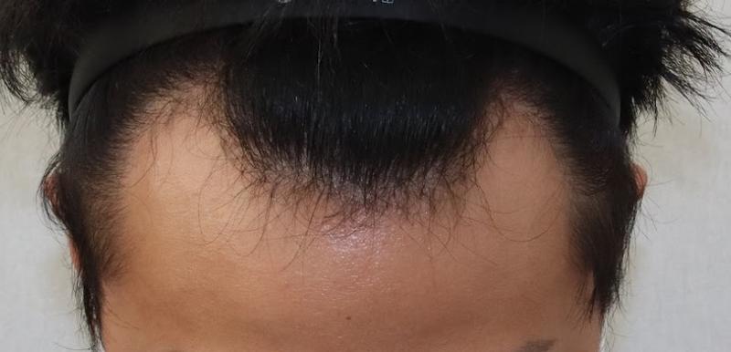 モディヘアプラント M字 脱毛 3000毛 9ヶ月 レビュー