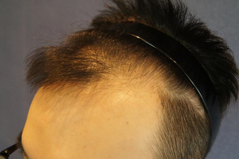 Motion 1200 hair follicle incision for 5 months