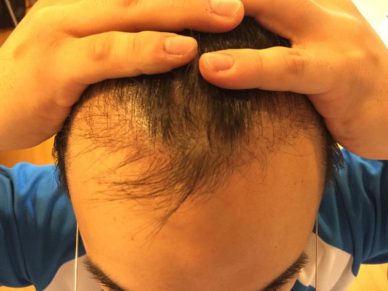 1200 Hair follicle non-cut hair transplant 1 month later