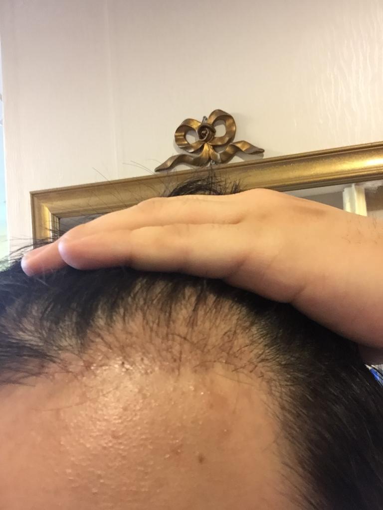 1,200 hair follicle non-excision for 3 months