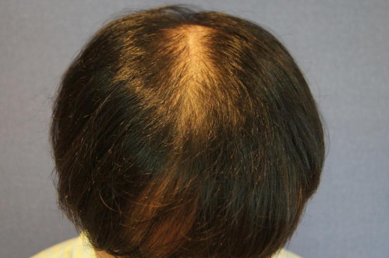 9 months of change after motion parietal 2000 hair surgery