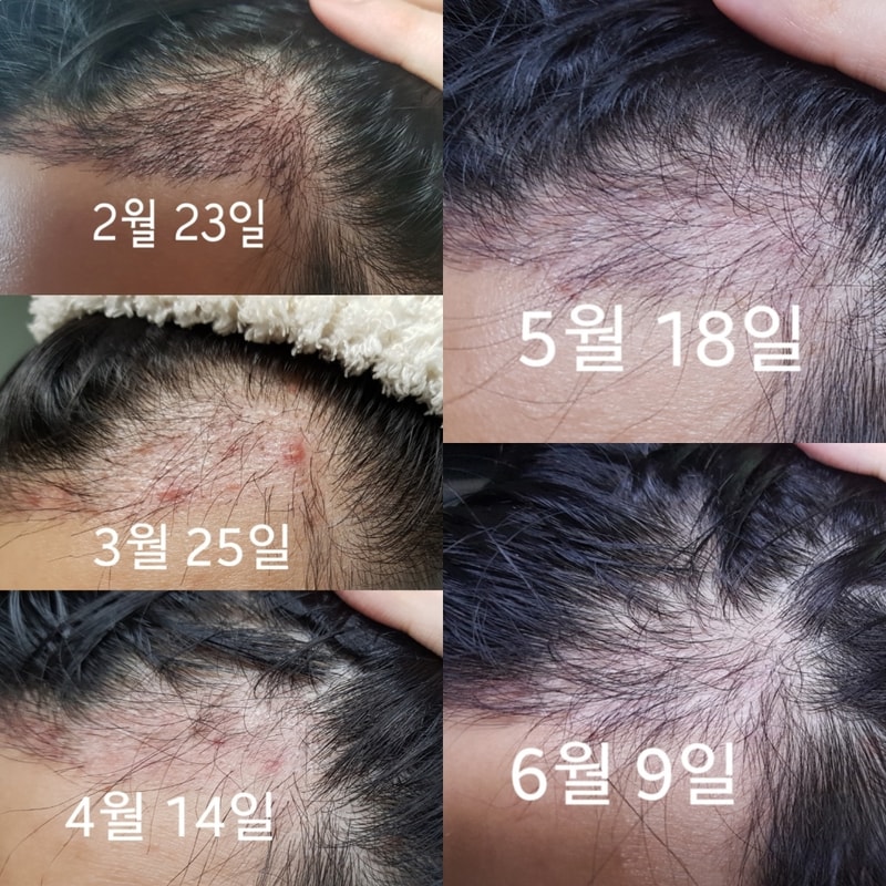 4달 경과입니다