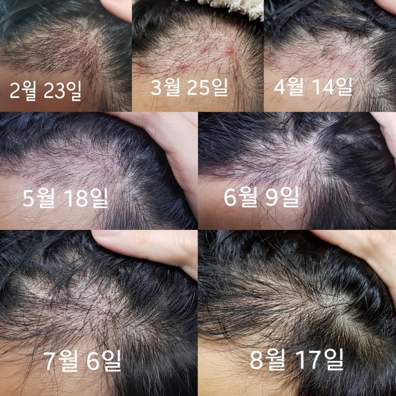 6개월반 경과