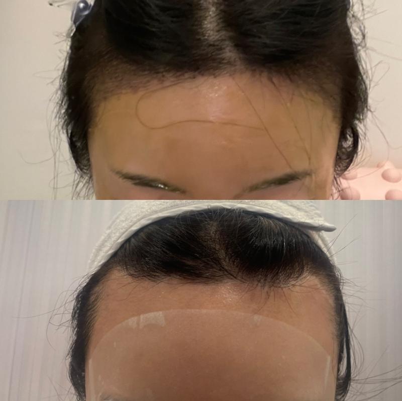 女性ヘアラインの手術直後のリアルレビュー！！