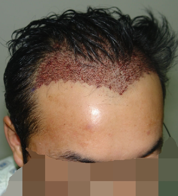 수술후1.jpg