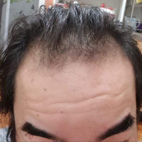 非切开3千毛，是第3天。