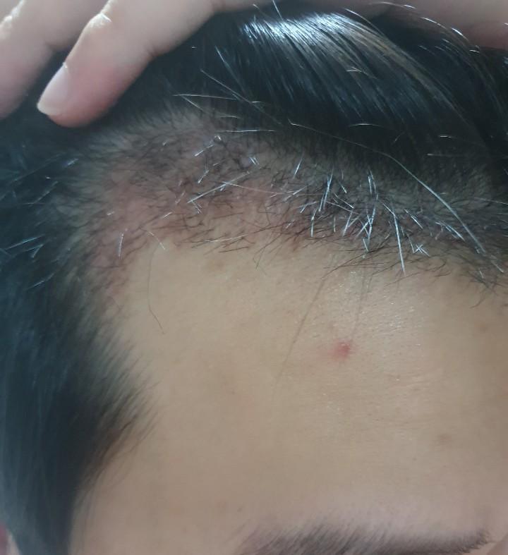Two months after the hair transplant