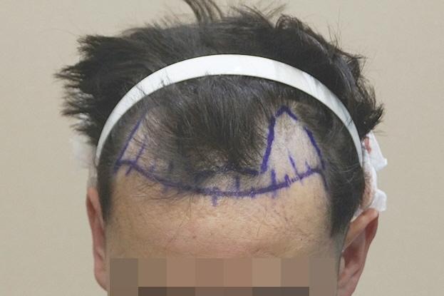 1600모낭 엠자 비절개 1년 완성 경과