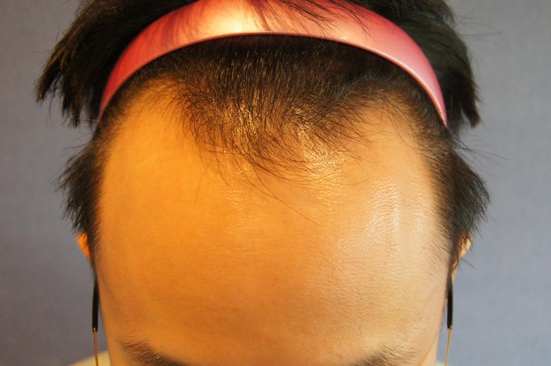 ヘアライン1400毛包移植8ヶ月です