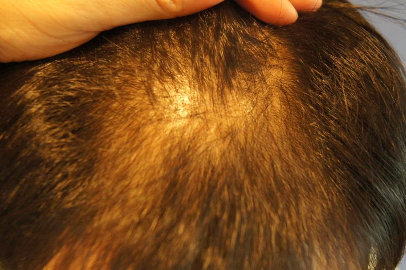 800 hair follicle non-excision 12 months old