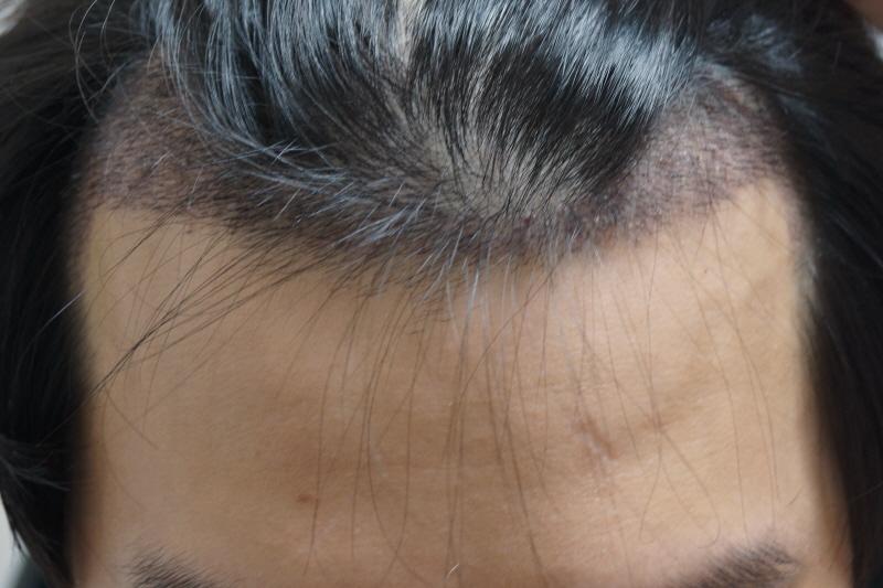 After 20 days of non-cut hair transplantation