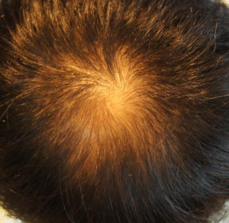 Motion Non-Cutting 2nd 400 Follicular Top of Head 1 Year and 3 Month Results