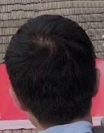 3年6个月的结果&药物停止1年6个月，头顶处于后发状态