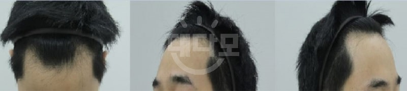 1200모낭 모발이식 10개월 후기사진