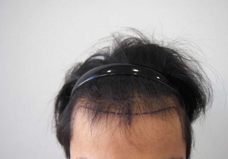 Non-cut partial cut 1100 hair follicles - 8 months later